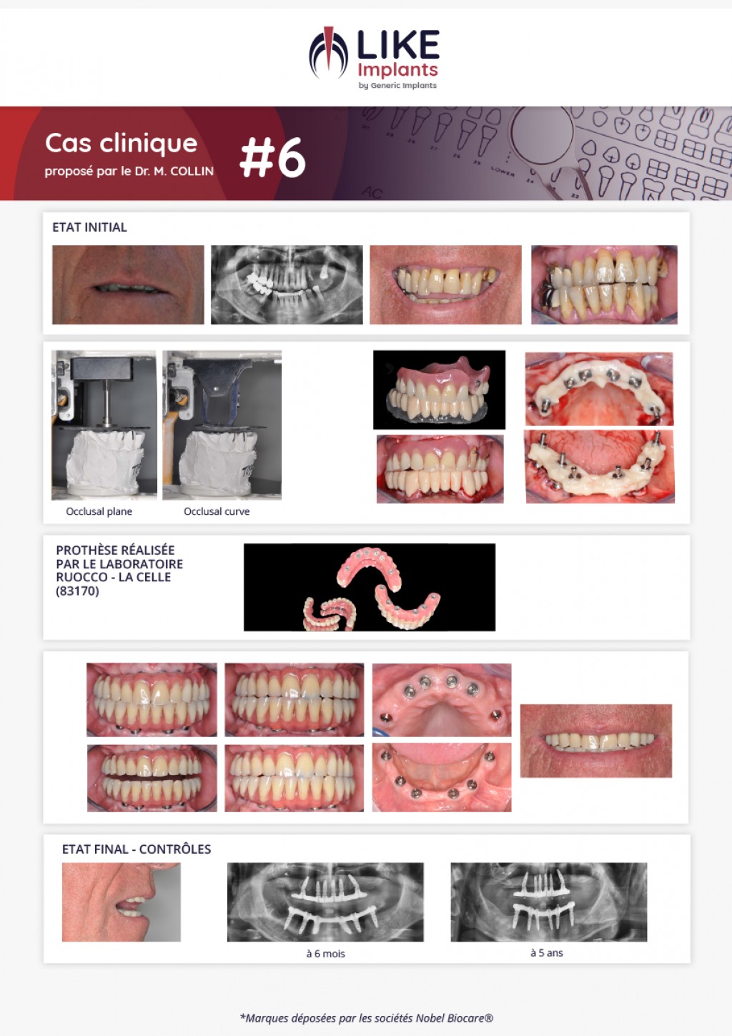 Parodontite terminale + absences dentaires - Cas clinique du Dr M. Collin