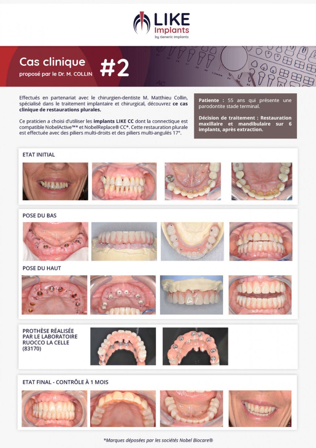 Parodontite stade terminale - Cas clinique du Dr M. Collin