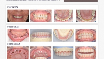 Parodontite stade terminale - Cas clinique du Dr M. Collin